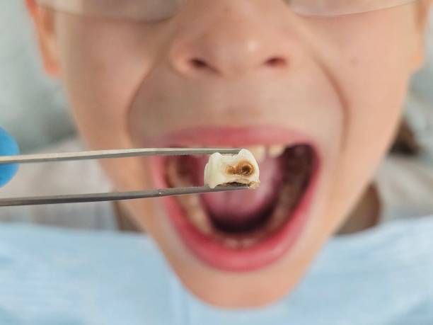 Best Emergency Treatment for Dental Infections or Abscesses in Pearl River, NY